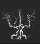 頚部の血管画像